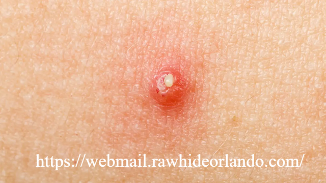 Mengungkap Penyebab Bisul dan Solusi Efektif