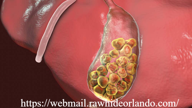 Memahami Batu Empedu: Penyebab